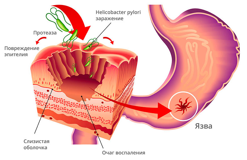 Прикрепление h pylori к стенке желудка Прикрепление h pylori к стенке желудка